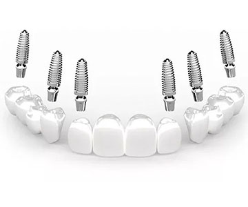 Implantes dentales en cancun