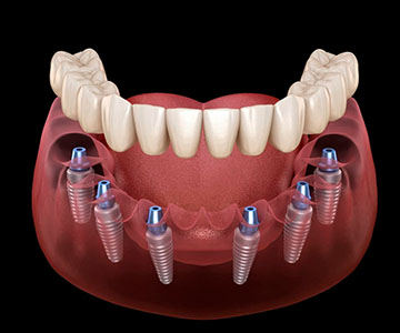 all on 4 dental implants cancun