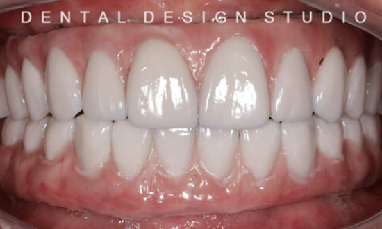 all on 4 dental implants cancun