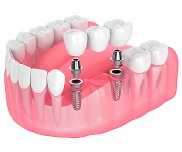 Corona metal - Laboratorio Dental 3D Natural Smile