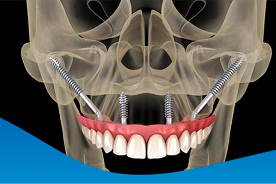 Implantes dentales en cancun