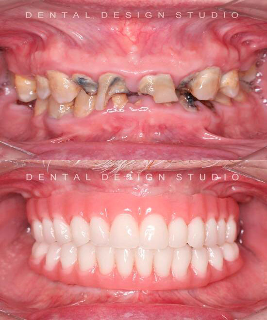 cancun all on 4 dental implants