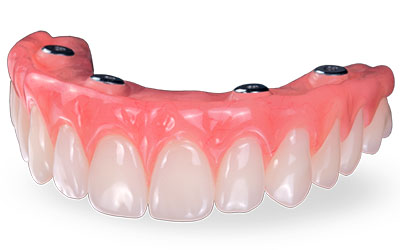 cancun all on 4 dental implants