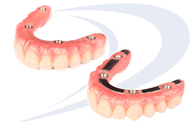 cancun all on 4 dental implants