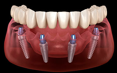 cancun all on 4 dental implants