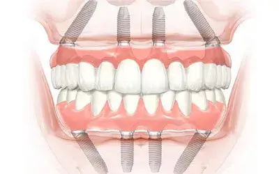 Best dentist in cancun