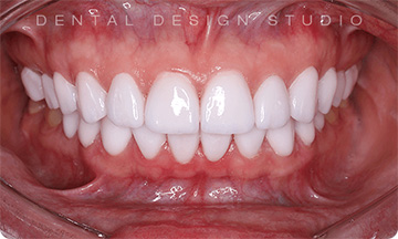 cancun cosmetic dentistry
