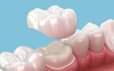 full mouth reconstruction cancun