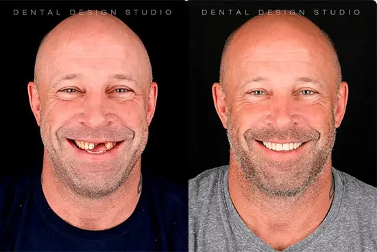 cancun dental implants