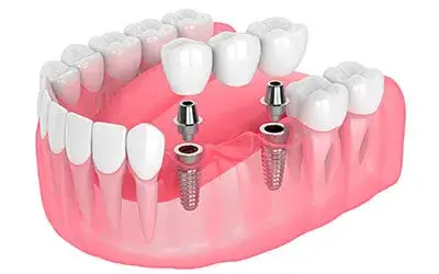 Best dentist in cancun