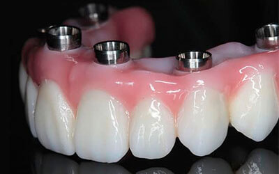 Zygomatic Dental Implants in Cancun
