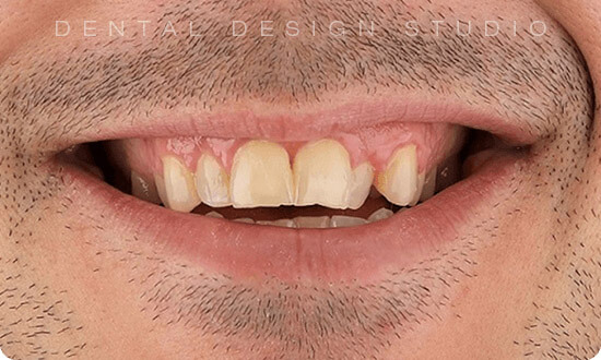veneers in cancun mexico