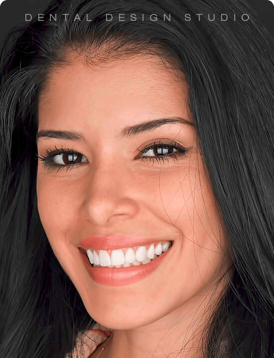 veneers in cancun mexico
